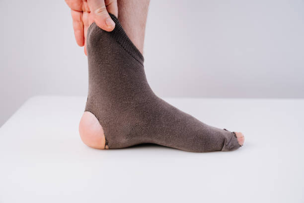 istock old holey sock on the leg 1306318437