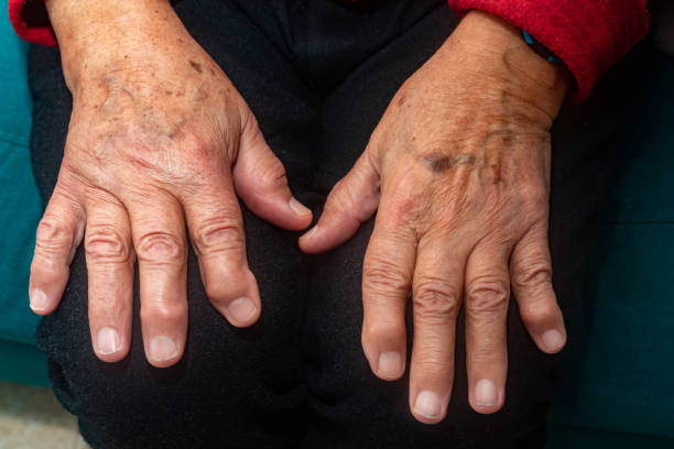 istock Hand of elderly person with osteoarthritis 1306389367