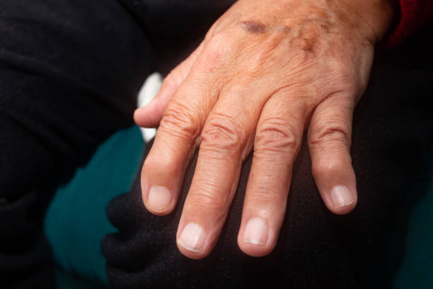 istock Hand of elderly person with osteoarthritis 1306389368