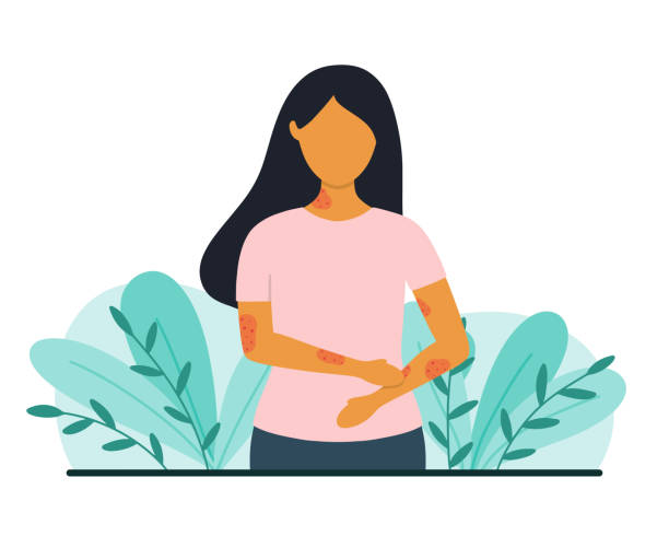 ilustraciones, imágenes clip art, dibujos animados e iconos de stock de mujer con problemas de piel. concepto de psoriasis o eccema. ilustración vectorial de estilo plano. - dermatología