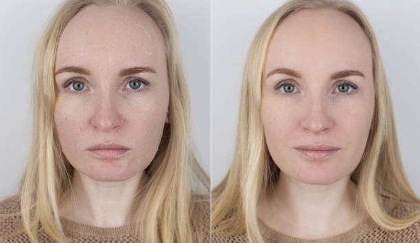 przed i po. kobieta bada suchą skórę na twarzy. peeling, ziarchiwanie, dyskomfort, wrażliwość skóry. pacjent na wizytę dermatologa lub kosmetologa. zbliżenie kawałków suchej skóry - human skin dry human face peeling zdjęcia i obrazy z banku zdjęć