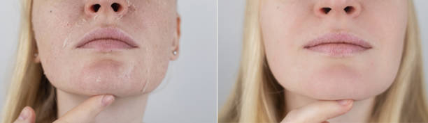 前と後。女性は顔の乾燥肌を調べる。剥離、粗大化、不快感、皮膚感受性。皮膚科医または美容師の予約時の患者。乾燥した皮膚の片のクローズアップ - human skin dry human face peeling ストックフォトと画像