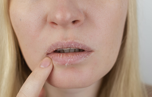 Una mujer examina la piel seca en sus labios. Peeling, engrosamiento, incomodidad, sensibilidad cutánea. Paciente a la cita de un dermatólogo o cosmetólogo. Primer plano de piezas de piel seca photo