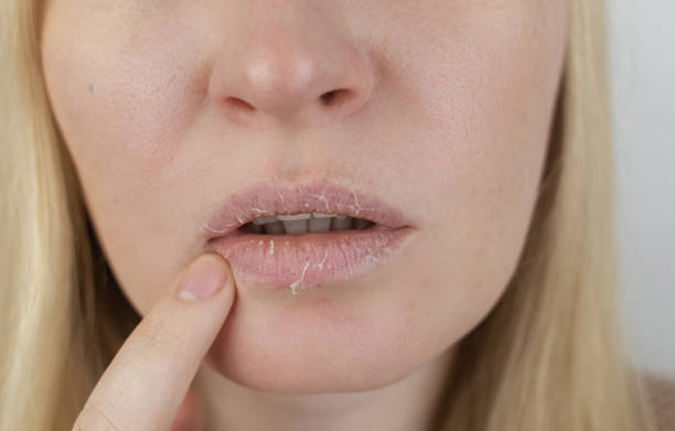 A woman examines dry skin on her lips. Peeling, coarsening, discomfort, skin sensitivity. Patient at the appointment of a dermatologist or cosmetologist. Close-up of pieces of dry skin stock photo
