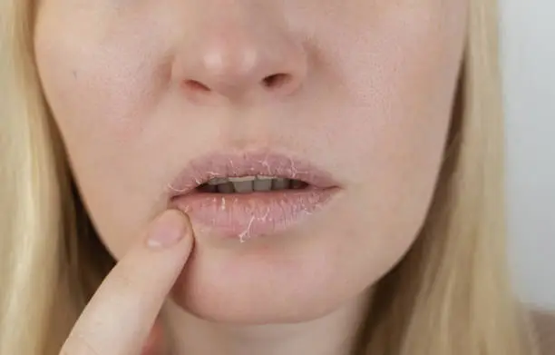 Patient at the appointment of a dermatologist or cosmetologist. Close-up of pieces of dry skin. A woman examines dry skin on her lips. Peeling, coarsening, discomfort, skin sensitivity.