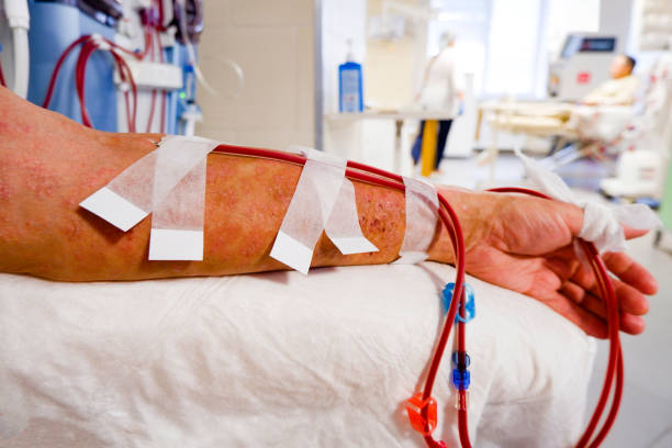 la mano de un paciente con una lesión cutánea está conectada a una máquina de hemodiálisis - blood filter fotografías e imágenes de stock