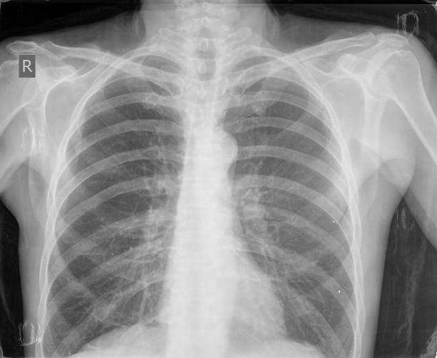 istock Chest xray imgages 1306535400