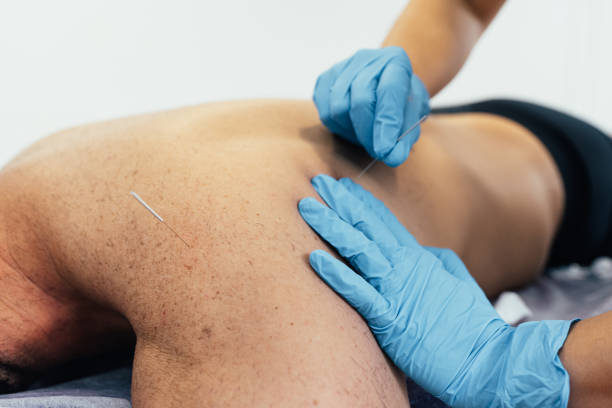 физиотерапевт проводит сухое игол на больного пациента с болью в спине. концепция здравоохранения - acupuncture needle стоковые фото и изображения