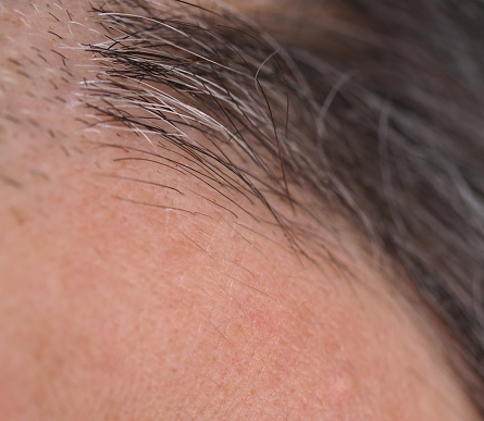 detail of hair follicle anchoring hairs to head skin