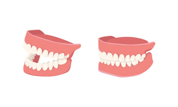 menschlicher mund mit zähnen isoliert auf weißem hintergrund. geöffnete und geschlossene backen. dental-modell der menschlichen kiefer. gesunde mundhygiene. trendige grafik für stomatologie, zahnarzt. vektor-illustration - dentures stock-grafiken, -clipart, -cartoons und -symbole