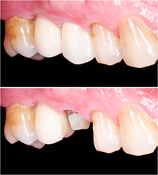 avant et après l’image pour le placement de couronne de zirkon - couronne dentaire photos et images de collection