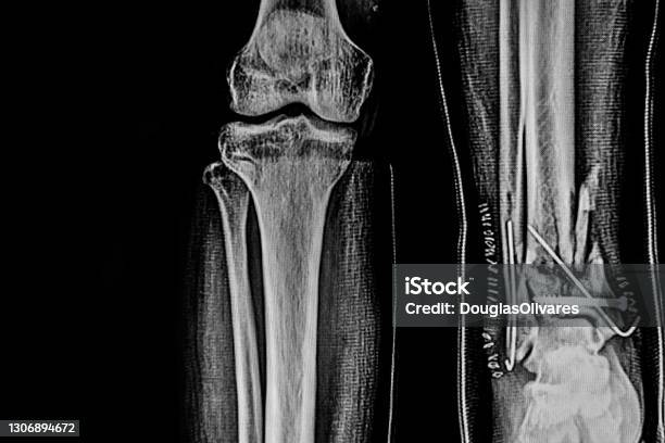 Rx Tibia And Fibula Bone Fracture With Rods Stock Photo - Download Image  Now - Adult, Anatomy, Black And White - iStock