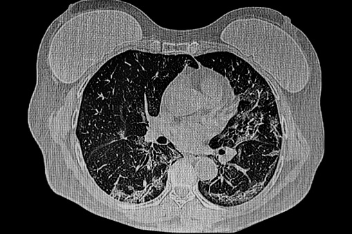 Chest CT SCAN of female patient with breast protesis and lung infection