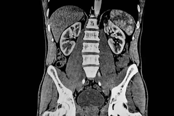 Photo of CT SCAN of abdomen showing liver, kidney and the spine