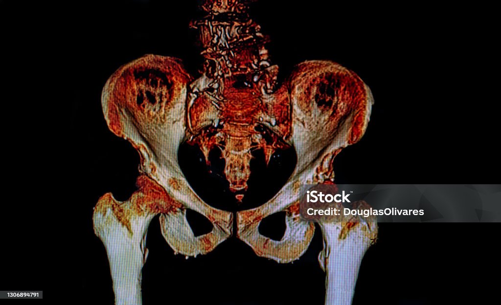 Rx image of pelvis bones Pelvic Floor Stock Photo