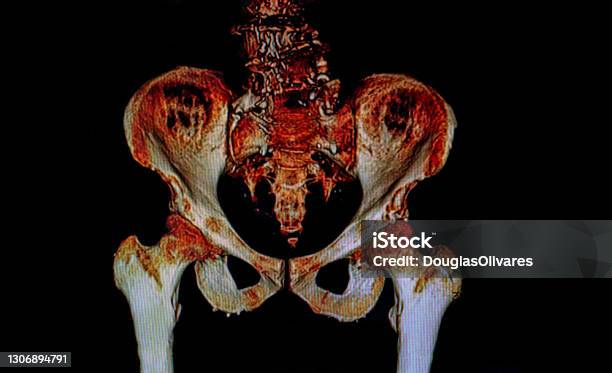 Rx Image Of Pelvis Bones Stock Photo - Download Image Now - Pelvic Floor, Anatomy, Healthcare And Medicine