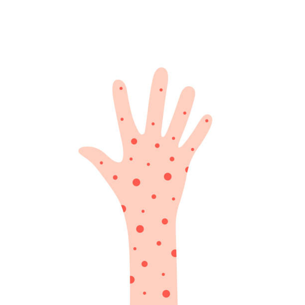 cartoon hand with rash like allergy cartoon hand with rash like allergy. concept of medical issue in man or woman or treatment atopic dermatitis. flat simple style trend modern dry skin graphic design isolated on white hand foot and mouth disease stock illustrations