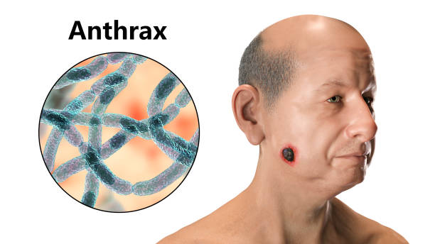 Cutaneous anthrax, the most common form of anthrax Cutaneous anthrax, the most common form of anthrax. 3D illustration showing the characteristic black eschar on the skin and closeup view of bacteria Bacillus anthracis eschar stock pictures, royalty-free photos & images