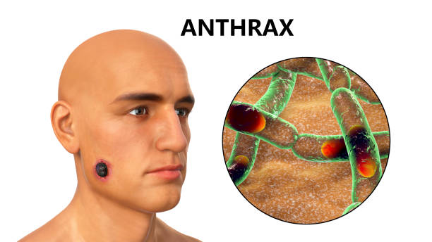 Cutaneous anthrax, the most common form of anthrax Cutaneous anthrax, the most common form of anthrax. 3D illustration showing the characteristic black eschar on the skin and closeup view of bacteria Bacillus anthracis eschar stock pictures, royalty-free photos & images