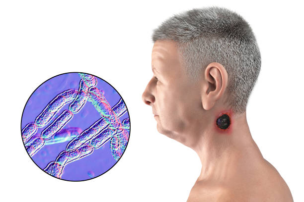 Cutaneous anthrax, the most common form of anthrax Cutaneous anthrax, the most common form of anthrax. 3D illustration showing the characteristic black eschar on the neck skin and closeup view of bacteria Bacillus anthracis eschar stock pictures, royalty-free photos & images