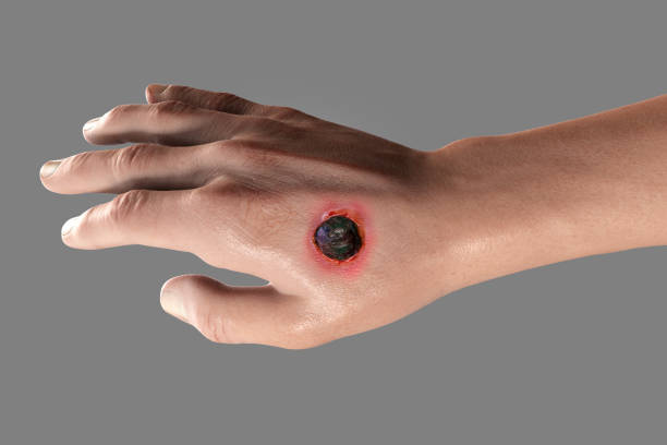 Cutaneous anthrax, the most common form of anthrax Cutaneous anthrax, the most common form of infection caused by bacteria Bacillus anthracis. 3D illustration showing the characteristic black eschar on the hand skin eschar stock pictures, royalty-free photos & images