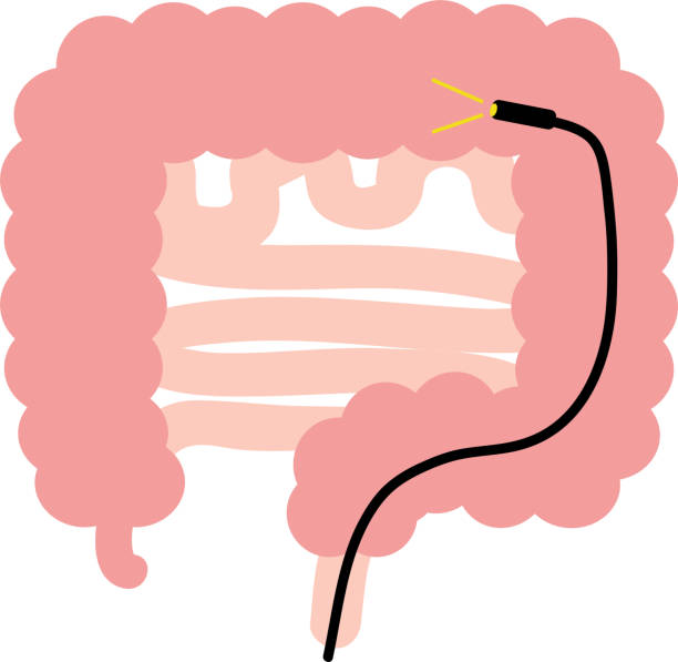 This illustration depicts a scope-type colonoscopy. This illustration depicts a scope-type colonoscopy. colon cancer screening stock illustrations