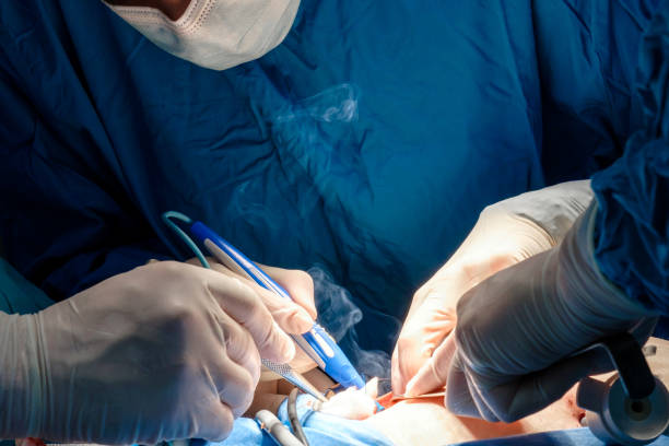 The surgeon holds the electrical coagulator during the operation. Smoke from burnt flesh. The surgeon holds the electrical coagulator during the operation. Close-up of hands in sterile gloves stained with blood. Blue uniform and medical masks. Smoke from burnt flesh. abdominal cavity stock pictures, royalty-free photos & images