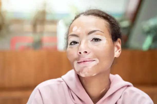 Photo of Black african american woman with vitiligo pigmentation skin problem indoor dressed pink hoodie