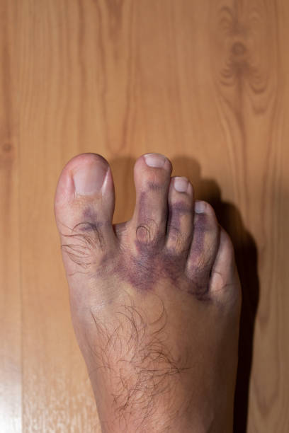 istock Man with bruise on the foot 1307398308