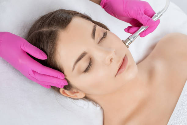 el cosmetólogo hace microdermabrasión del procedimiento en la cara contra el acné y las cabezas negras cerca de los ojos. cosmetología femenina en el salón de belleza. - dermatology dermabrasion surgery medical fotografías e imágenes de stock