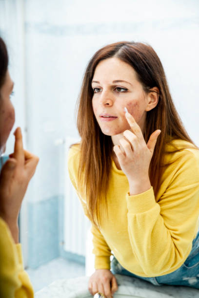 Young woman with problem skin applying treatment cream at home -  Concept about skin care Young woman with problem skin applying treatment cream at home -  Concept about skin care bacterial mat photos stock pictures, royalty-free photos & images