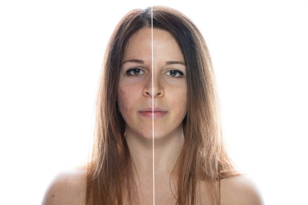 Woman face before and after acne treatment procedure -  Concept about skin care Woman face before and after acne treatment procedure -  Concept about skin care bacterial mat photos stock pictures, royalty-free photos & images