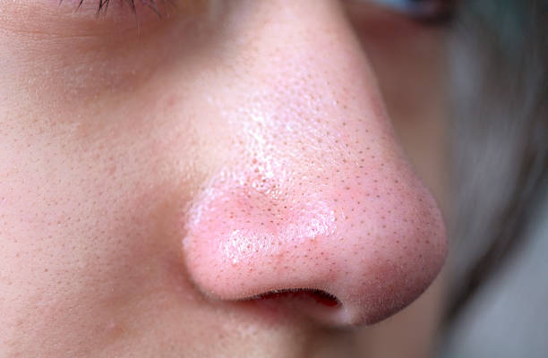 boutons, acné, zit, points noirs sur le nez de la photo stock adolescent - nez humain photos et images de collection