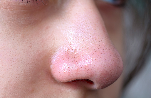 Pimples, acne, zit, blackheads on the nose of teenager stock photo