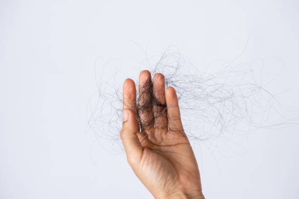 istock hair loss problem on hand isolated on white background 1307664345
