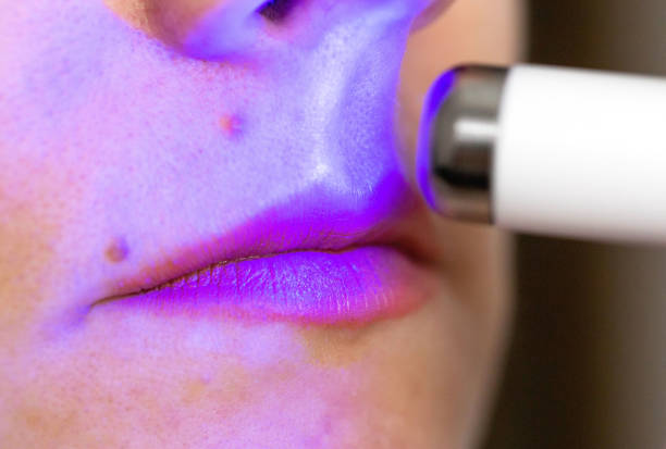 Girl treats inflamed red acne on the skin of the face with a laser cosmetic pen, cosmetic procedure. Macro Girl treats inflamed red acne on the skin of the face with a laser cosmetic pen, cosmetic procedure. Dermatologist laser pen stock pictures, royalty-free photos & images