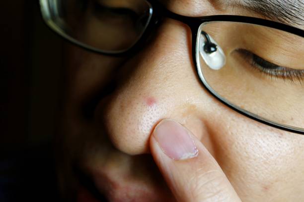 istock Acne in the nose of men 1307751632