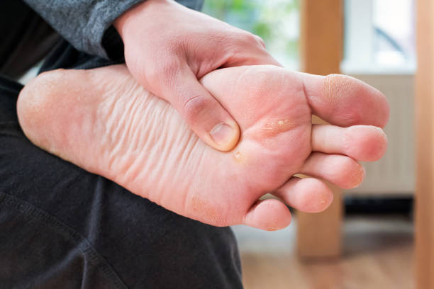 pé com milhos, calos e pele seca, verrucas plantar de verruga. vírus verrucas papilloma calo, doença na pele do pé. perna de pé insalubre com milho de perto. homem mostra calosidade antes do tratamento - sole of foot - fotografias e filmes do acervo