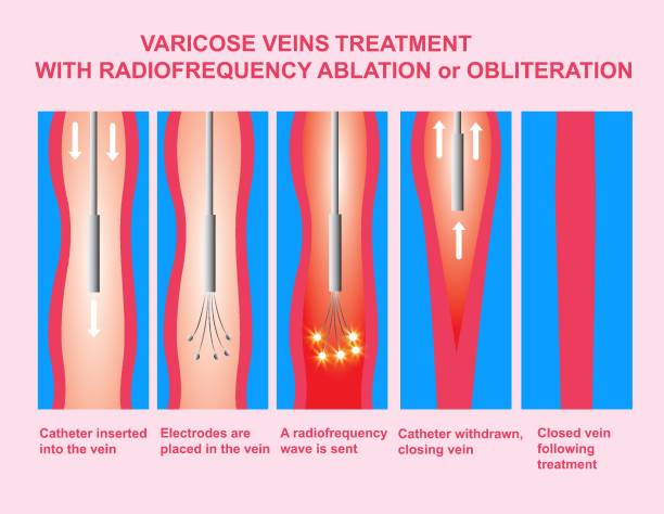 illustrations, cliparts, dessins animés et icônes de varices et traitement par ablation par radiofréquence - venous insufficiency