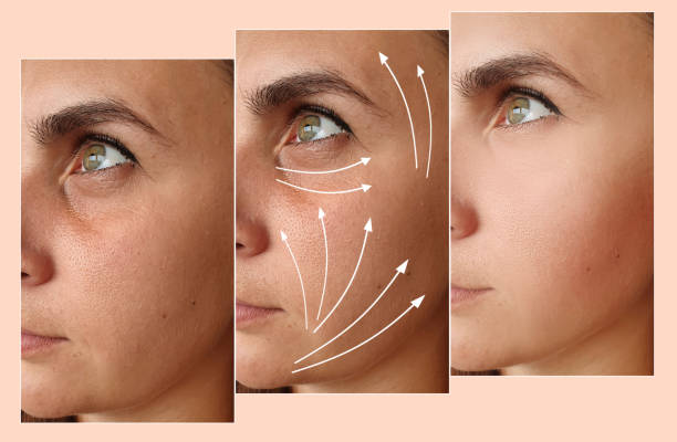 woman face lift before and after treatment woman face lift before and after treatment botox before and after stock pictures, royalty-free photos & images