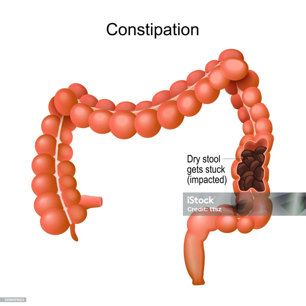 Constipation Images Examples Constipation Stock Illustration - Download Image Now - Colon ...