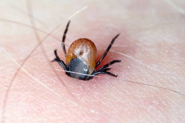 istock Tick with its chelicerae sticking in human skin. 1308063581