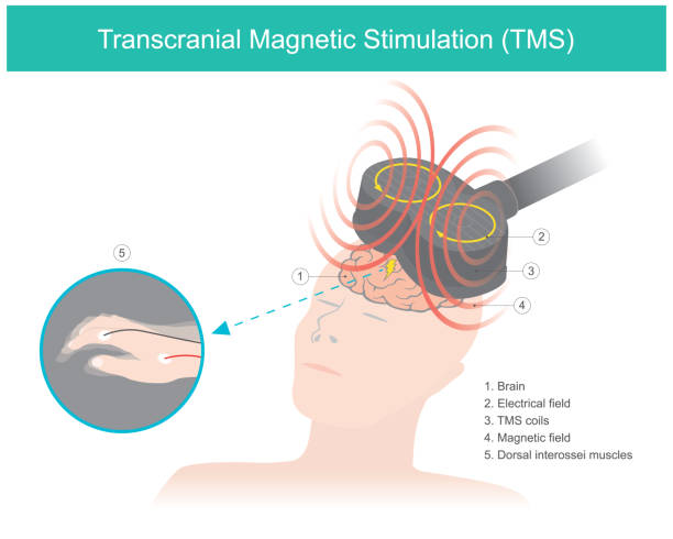 Transcranial Magnetic Stimulation (TMS). Transcranial Magnetic Stimulation (TMS). The brain stimulation in which a changing magnetic field is used to cause electric current. Healthcare and medical illustration."n magnet stock illustrations