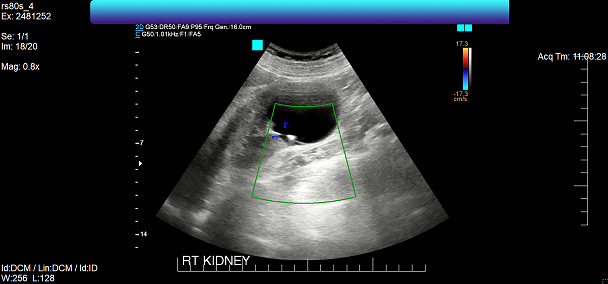 There is a cortical cyst in the lower pole of the right kidney measuring 6.1 x 6.1 x 6.1 cm, with the upper thin posterior separation containing calcification 3 mm thick.  This is most probably benign Bosniak 2-2F. No suspicious renal mass, stone or hydronephrosis.  The unopacified renal collection system appears grossly normal.