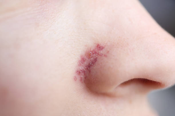 sulle ali del naso, pelle dopo la rimozione della rete vascolare - naso rosso foto e immagini stock