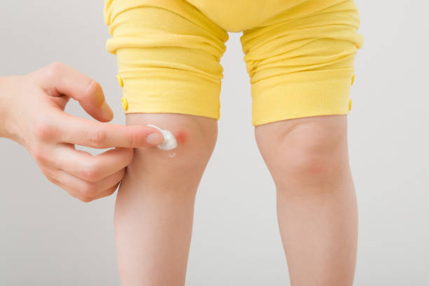 Female finger applying medical ointment on abrasion knee skin of toddler. Isolated on light gray background. Mother giving first aid. Closeup. Front view. Female finger applying medical ointment on abrasion knee skin of toddler. Isolated on light gray background. Mother giving first aid. Closeup. Front view. toddler hitting stock pictures, royalty-free photos & images