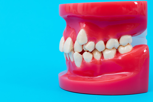 Crooked teeth model on blue background.