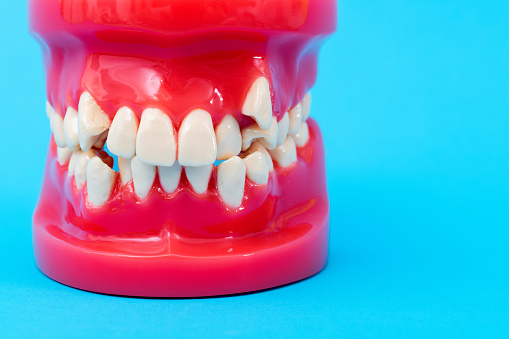 Crooked teeth model on blue background.