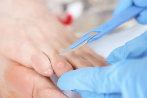 Doctor removes callus with scalpel. Podiatry medical services concept