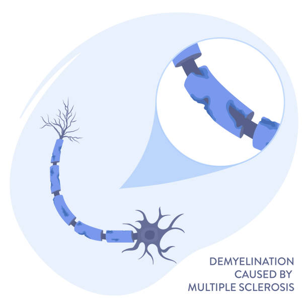 Multiple Sclerosis Process 250+ Multiple Sclerosis Icon Stock Illustrations, Royalty-Free Vector ...